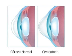 Imagem Ceratocone