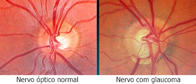 Imagem Olho Glaucoma